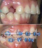 Gigi atas maju (7)