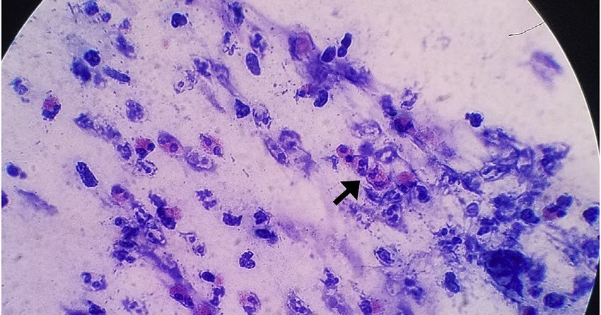 Sputum Cytology