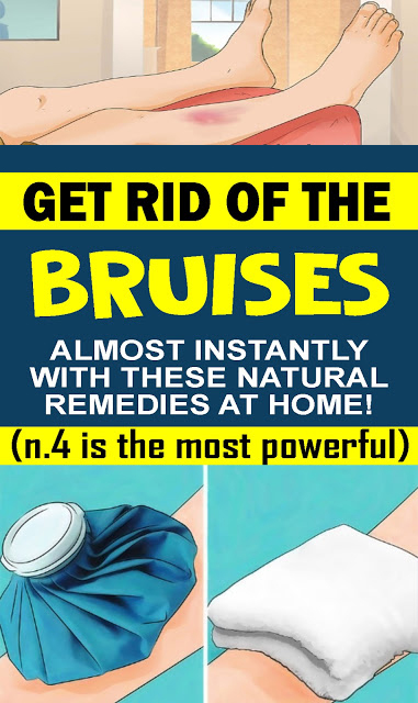 How To Get Rid Of Bruises Naturally Healthy To Me
