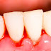 Điều trị chảy máu chân răng khi niềng răng 