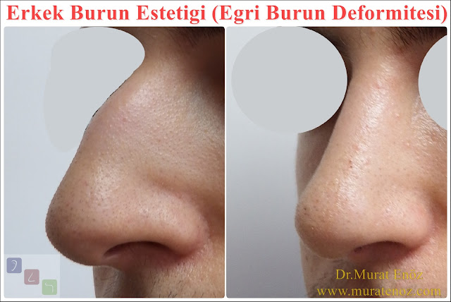 Crooked nose - Deviated nose - Twisted nose - Deflected nose - Asymmetric nose - Scoliotic nose - Eğri burun - C burun - S-shaped crooked nose deformity -  Rhinoplasty Istanbul - Rhinoplasty in Istanbul - Rhinoplasty Turkey - Rhinoplasty in Turkey – Rhinoplasty doctor in Istanbul – ENT doctor in Istanbul - Nose Job in Istanbul - Before and after rhinoplasty photos