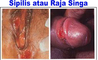 Berapa Harga Obat Sipilis Gangjie Ghosiah Di Dairi Sidikalang Sumatera Utara