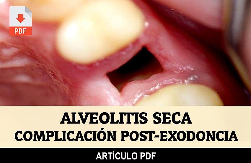 Pdf Alveolitis Seca Complicación Post Exodoncia 