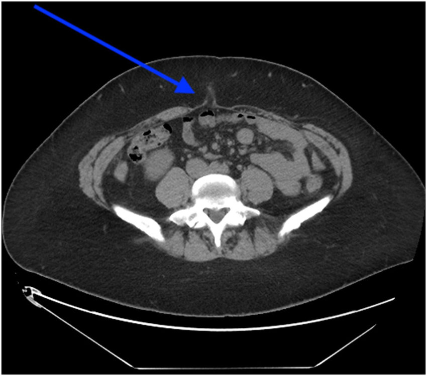 Diagnosis and treatment of Umbilical Hernia