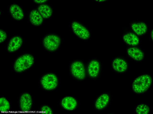 Anticorpos anti - Sm e anti - RNP