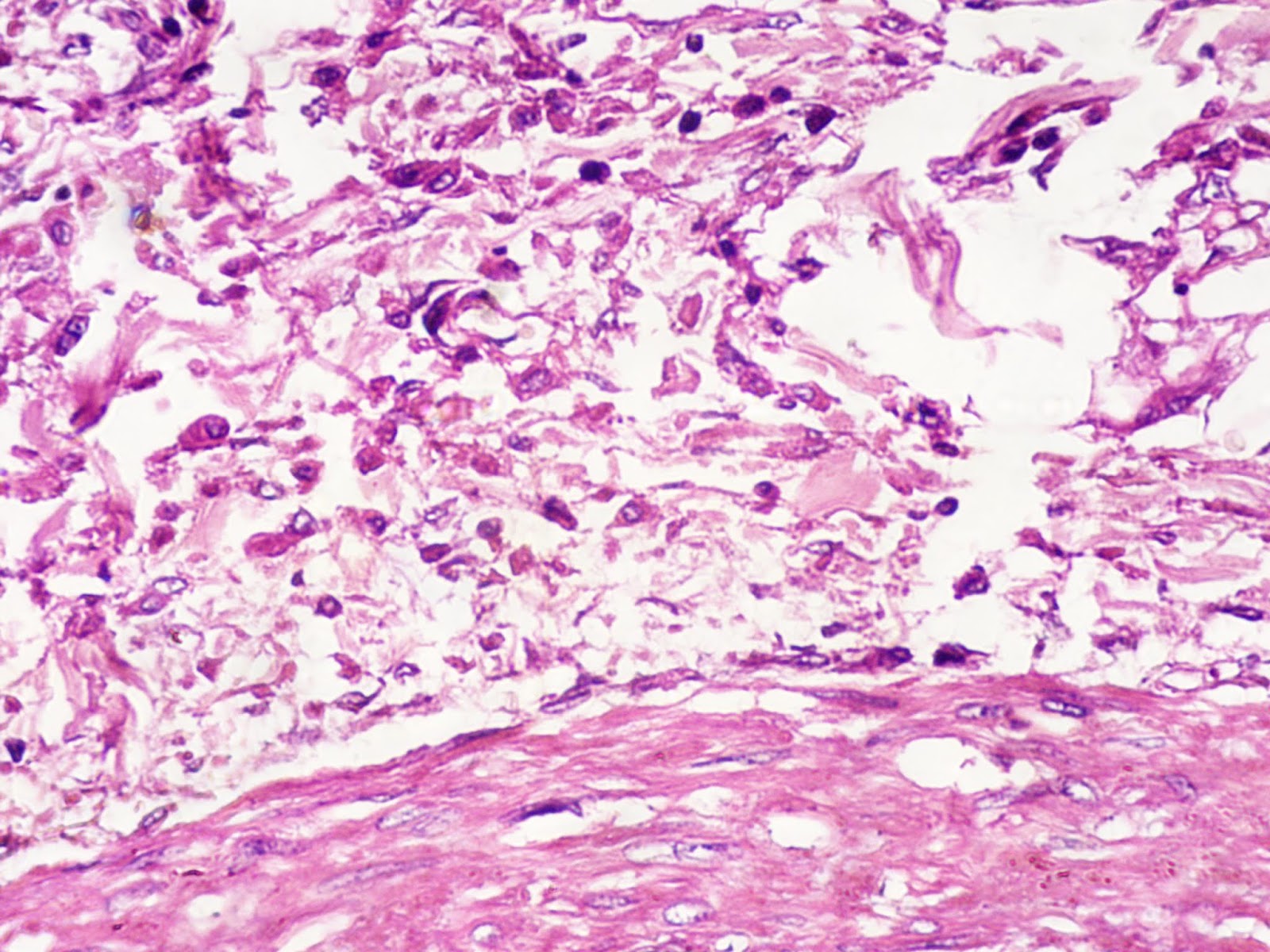 into the roots Pericarditis