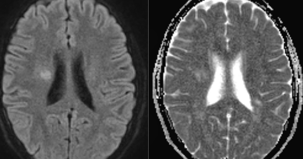 Active MS plaques on DWI