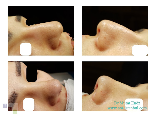 Nose Tip Plasty in Women, Nose Tip Aesthetic Surgery in Female, Nose Tip Lifting,Droopy Nose Tip Aesthetic in Istanbul, Sarkık Burun Ucu Estetiği