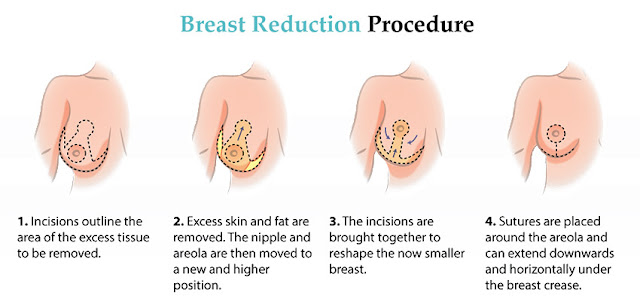 breast-reduction-procedure