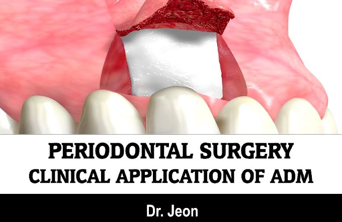 PERIODONTAL SURGERY: Clinical Application of ADM - Dr. Jeon