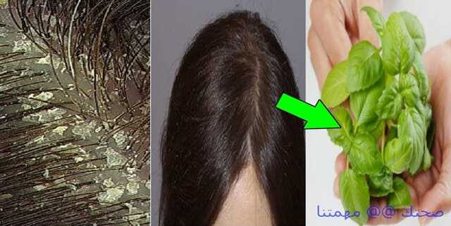 غاز استوائي اندفاع  اعشاب لعلاج قشرة الشعر