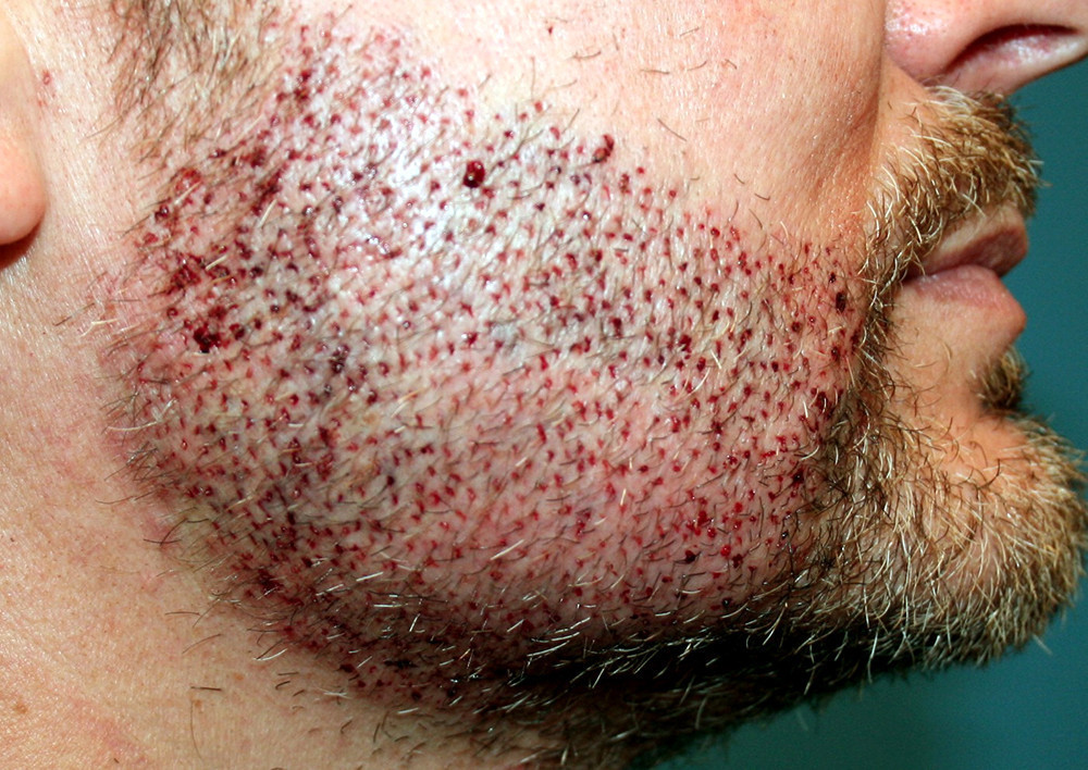 How Can Beard Hair Transplant In Ludhiana Can Change The Life Of A Man