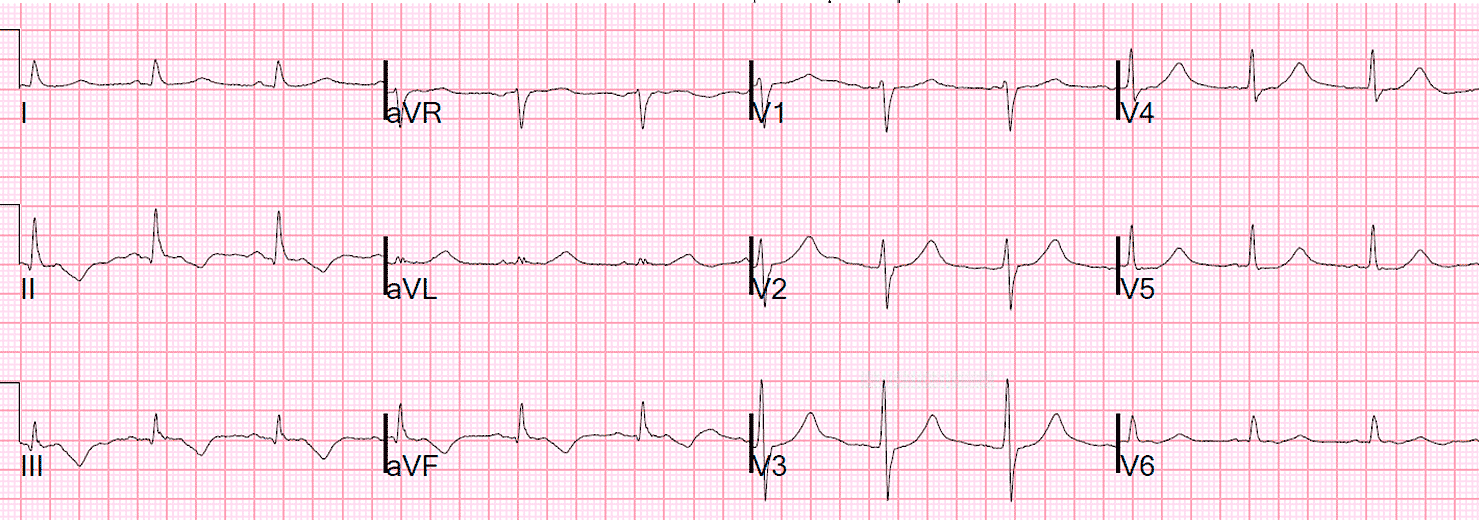 кардиограмма v1