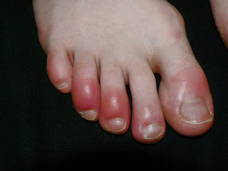 Toes inflamed