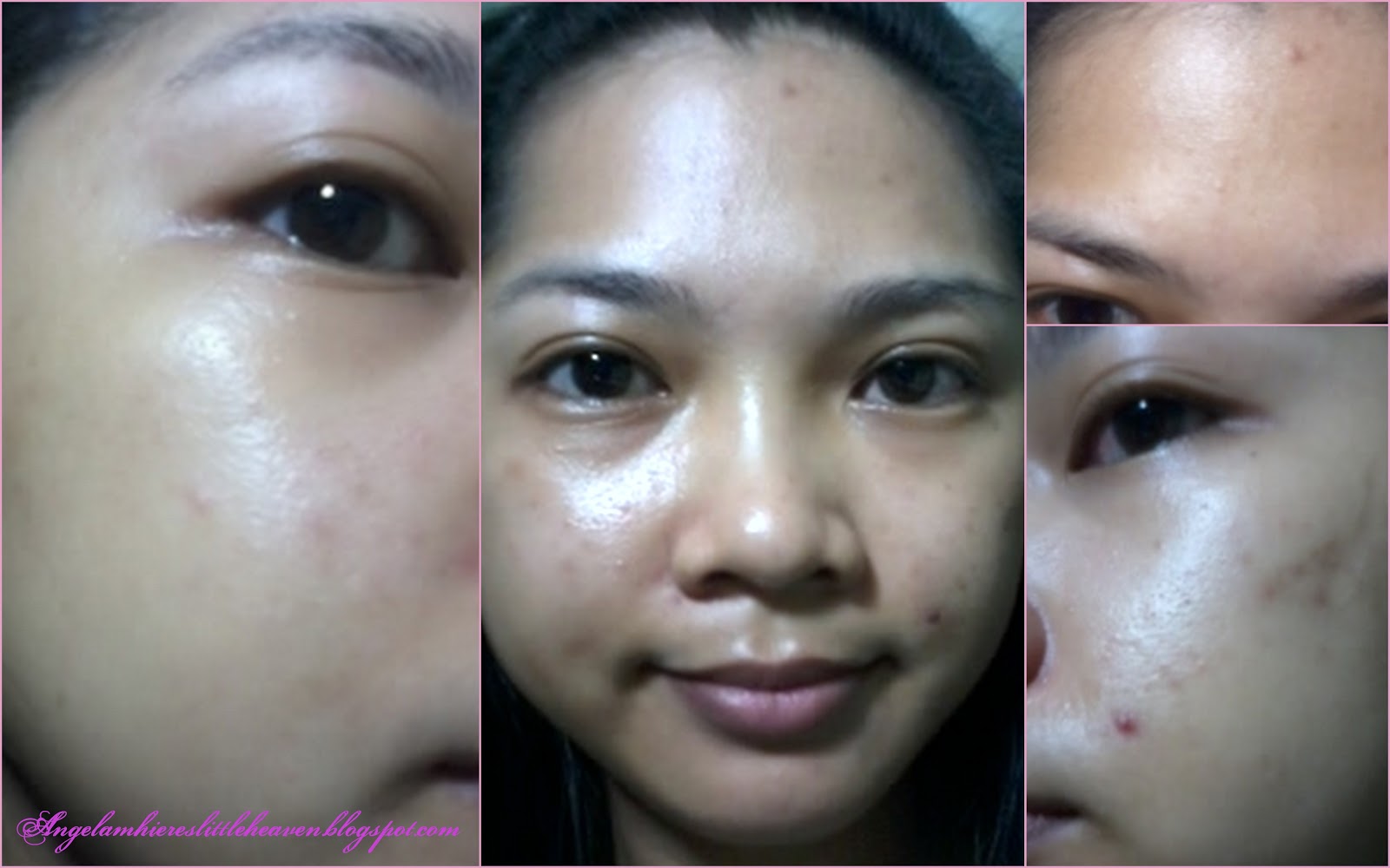 Type 2 Diabetes - Skin Care Tips For Diabetics, Part 2