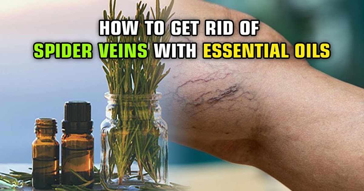 HOW TO GET RID OF SPIDER VEINS WITH ESSENTIAL OILS ~ KrobKnea