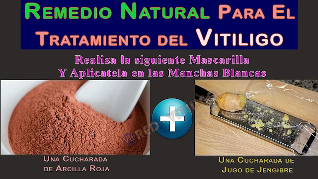 Mascarilla de jugo de jengibre y arcilla roja para tratar manchas blancas del Vitiligo