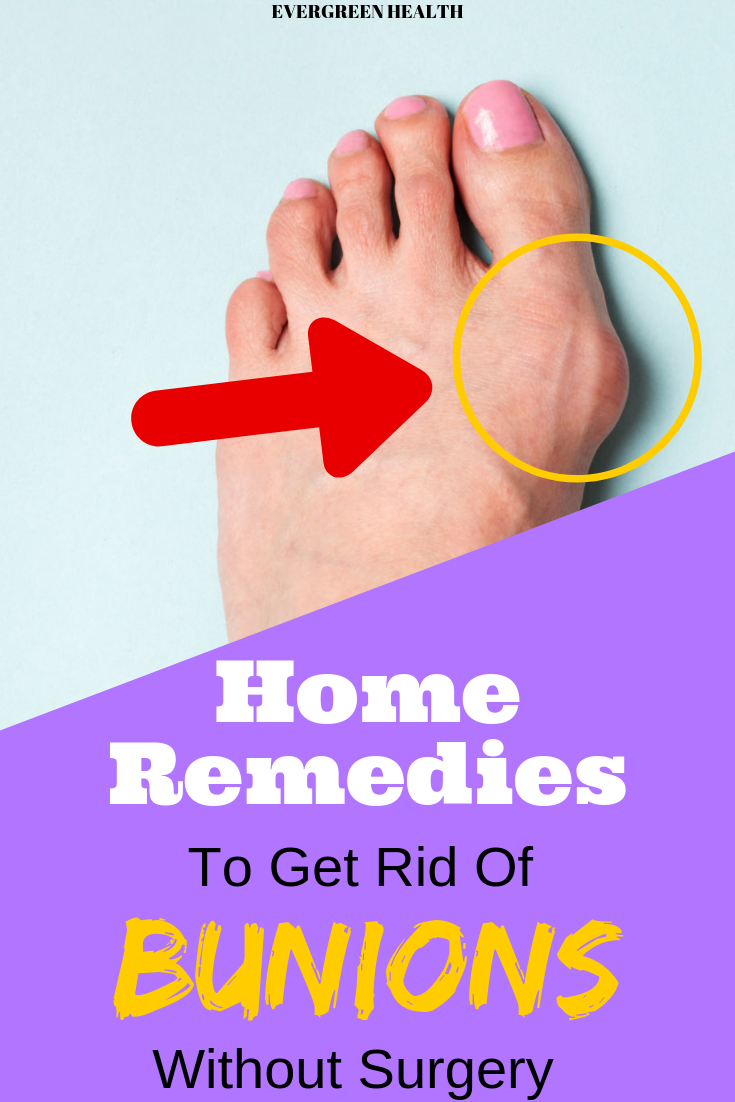 EVERGREEN HEALTH Home Remedies To Get Rid Of Bunions Without Surgery
