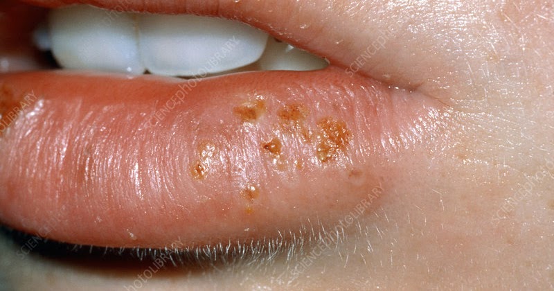 Cara Terampuh Asli Mengatasi Penyakit Herpes Simplex Pria Wanita
