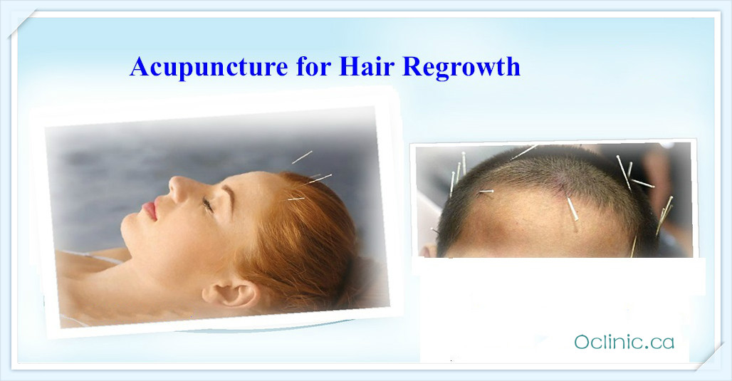 Acupuncture Massage Clinic Scarborough: Acupuncture for hair loss : Does it  work?