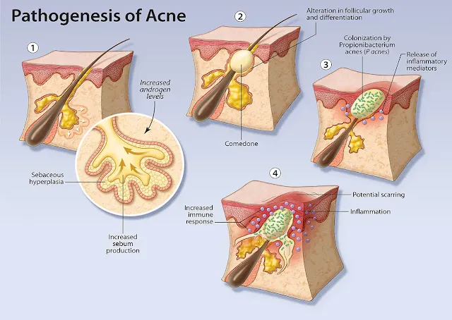 proses terjadinya jerawat hingga sembuh
