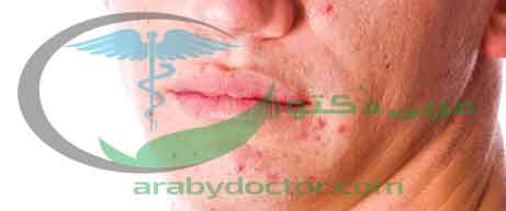 حب الشباب|علاجه ,اسبابه,كيف تتجنبه حب الشباب|علاجه ,اسبابه,كيف تتجنبه