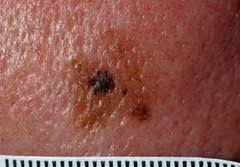 Melanoma-a dangerous disease (cancer)