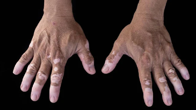 Pacientes con vitiligo pueden someterse a tratamiento novedoso con menor estabilidad de la enfermedad.