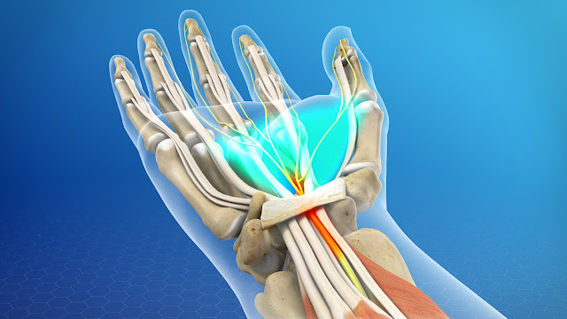 is a pinched condition of the median nerve at the wrist caused by Carpal Tunnel Syndrome