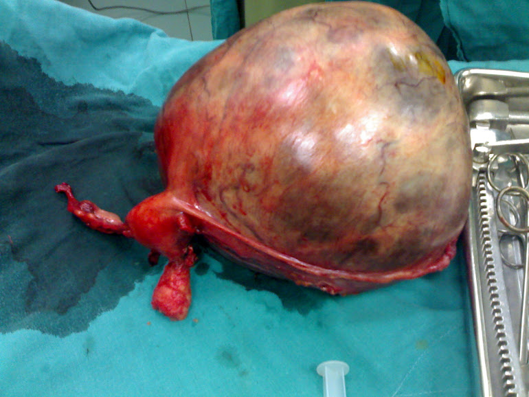 Huge left ovarian tumor - TAH and BSO done by DR. Alaa Mosbah