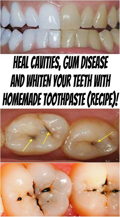 7 AIMS HEAL CAVITIES, GUM DISEASE AND WHITEN YOUR TEETH WITH HOMEMADE