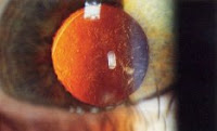 After cataract - Posterior capsular opacification post-cataract surgery(seen on retroillumination)