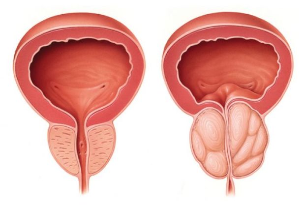 Prostate Hyperplasia ICD A prosztatitis az ágyékban ad