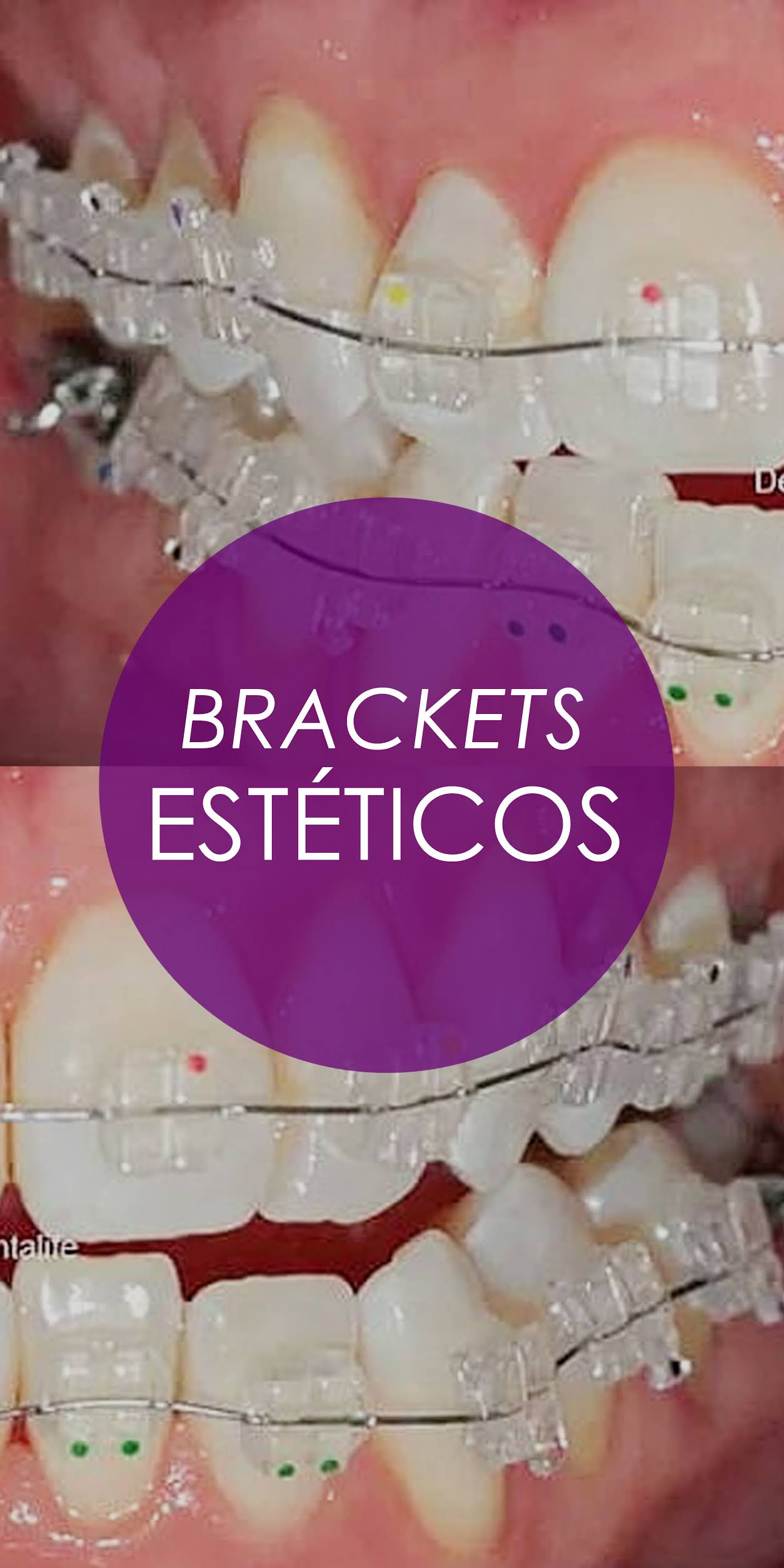 TODO SOBRE LOS BRACKETS TRANSPARENTES Brackets Veracruz Ortodoncia