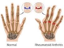 Cara Menyembuhkan Artritis Reumatoid