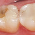 Răng bị vỡ có nên nhổ không?