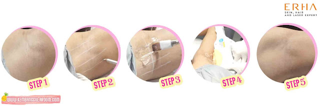 nyobain hair removal by ipl di erha clinic