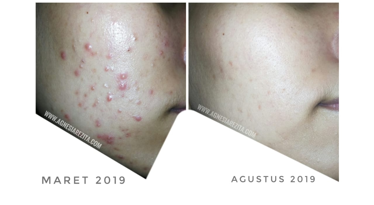 12+ Acnes Treatment Series
 PNG