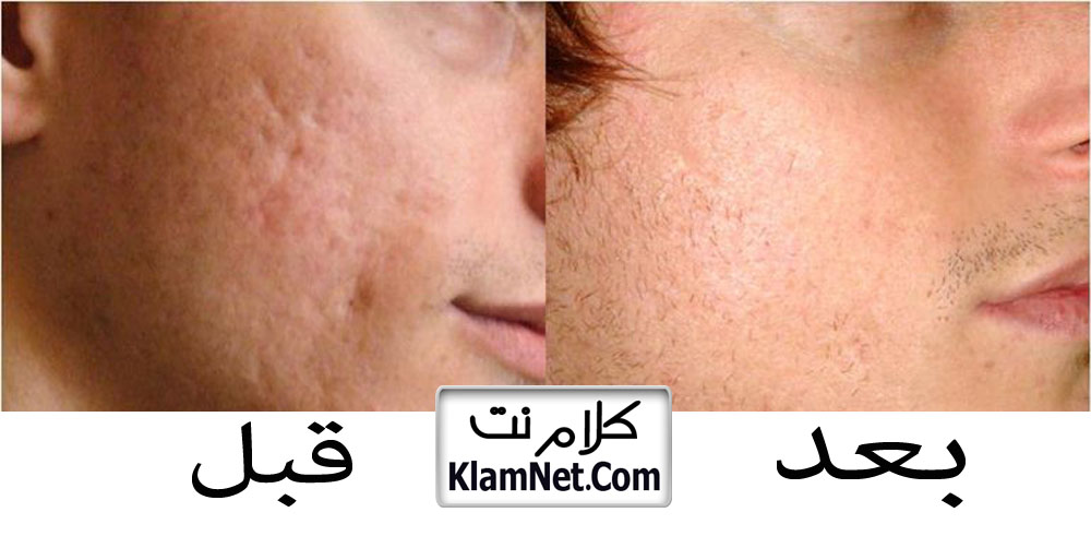 طريقة سهلة جدا لعلاج الندبات وحفر الوجه علاج اثار حب الشباب موقع كلام نت