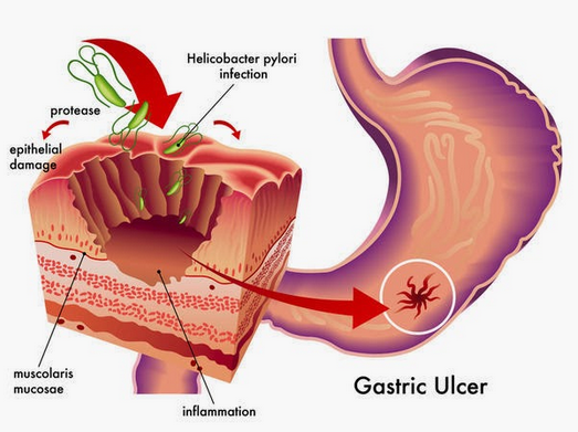 Pengobatan Bakteri Lambung