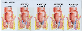 Obat Ambeien Sangat Ampuh di Apotik Terdekat