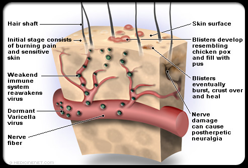 Shingles ilustration