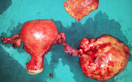 Rt malignant ovarian tumor .TAH & BSO& Omentectomy