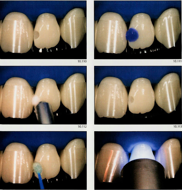 Class III Composite restoration " Labial access " Dental Esthetics