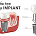 Quy trình cấy ghép răng implant