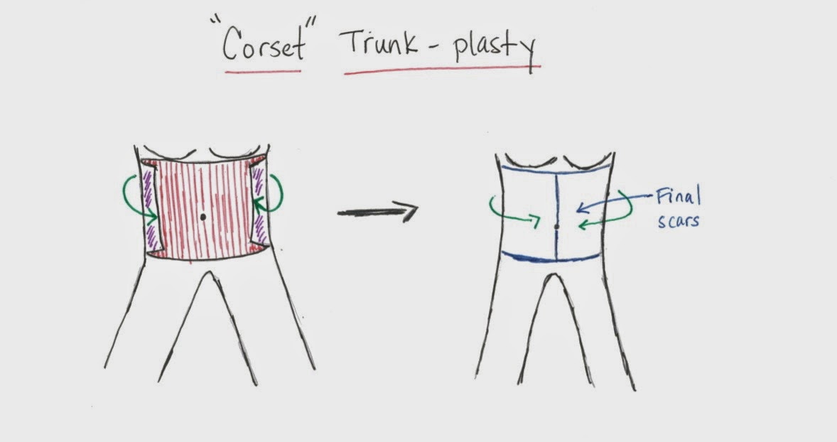 Weight Loss and Body Contouring Central The Corset "TrunkPlasty"