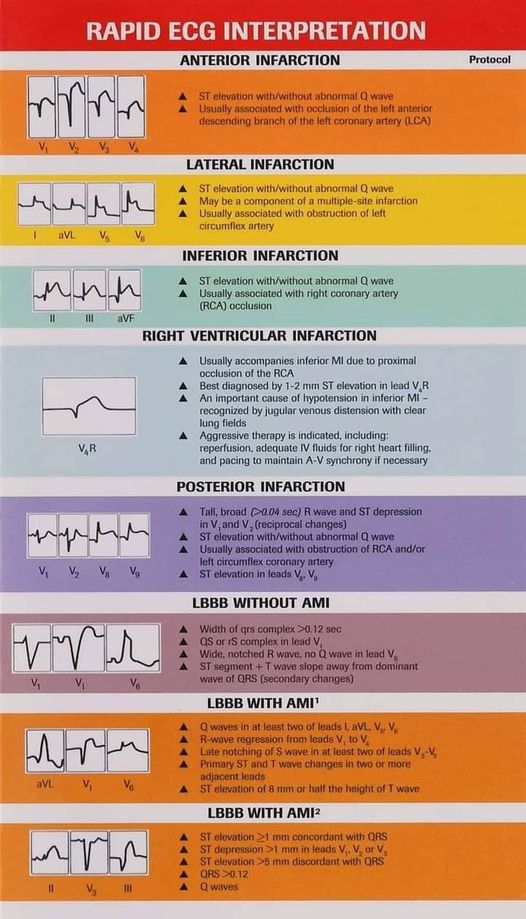 ZONA DE SALUD DE OFRA Guía Básica rápida de interpretación de un ECG.