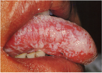 Oral Hairy Leukoplakia’(OHL)
