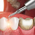 Cạo vôi răng dưới nướu có nguy hiểm không?