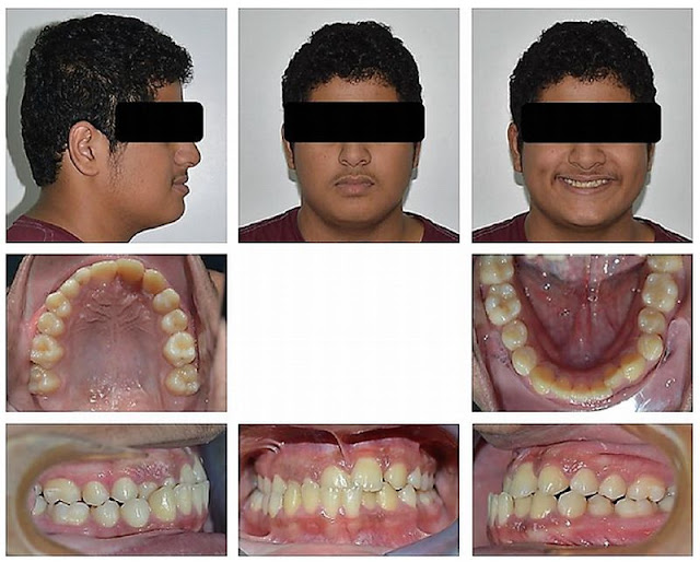 CLINICAL CASE Nonsurgical Treatment of Class III Malocclusion with
